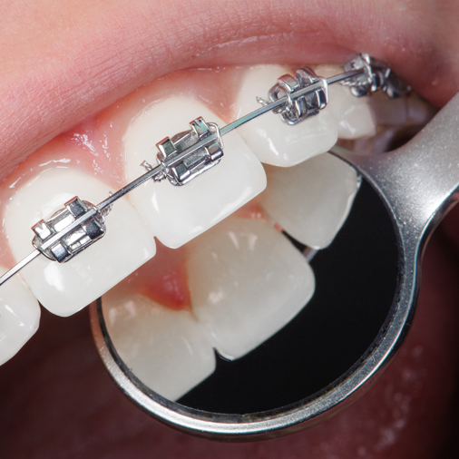 Powell Family Dentistry - Orthodontics in Powell Tennessee